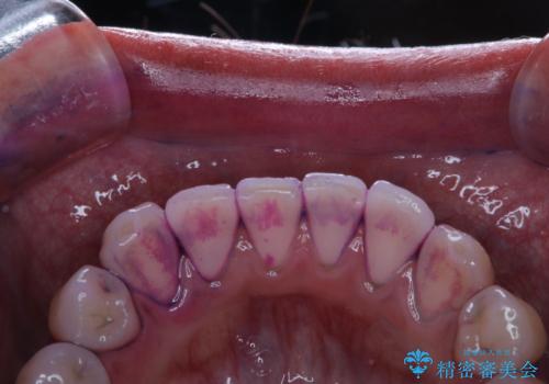 日々の磨き残しをPMTCできれいにの治療前