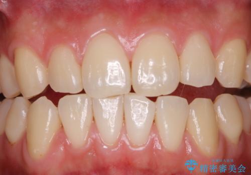 日々の磨き残しをPMTCできれいにの治療後