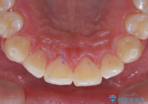 日々の磨き残しをPMTCできれいにの治療後