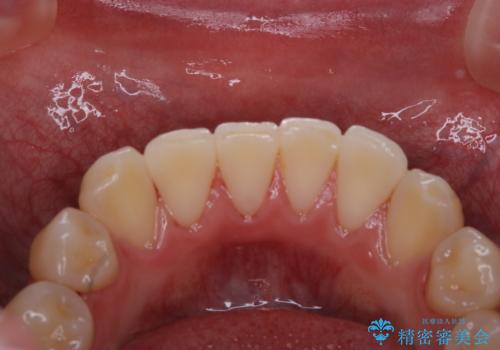 日々の磨き残しをPMTCできれいにの治療後