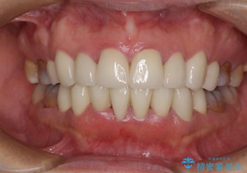 矯正の後戻りと変色歯を治したい　総合歯科診療の症例 治療後