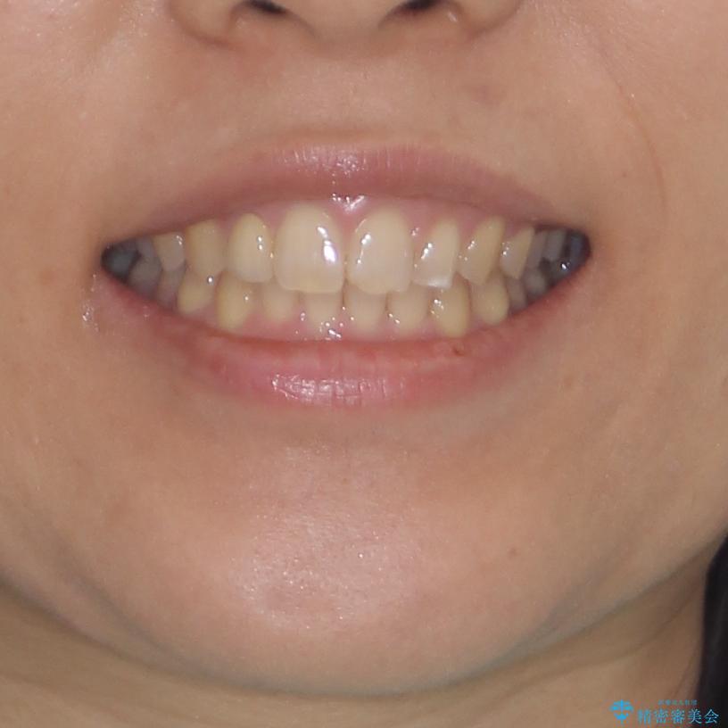 前歯の歯並びと小さい歯を改善　インビザラインとオールセラミッククラウンの治療後（顔貌）