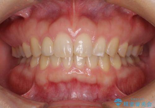 前歯の歯並びと小さい歯を改善　インビザラインとオールセラミッククラウンの症例 治療後
