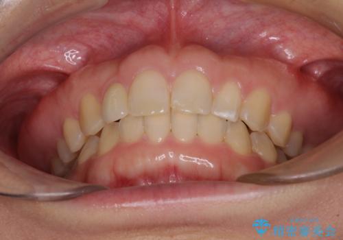 前歯の歯並びと小さい歯を改善 インビザラインとオールセラミッククラウンの治療後