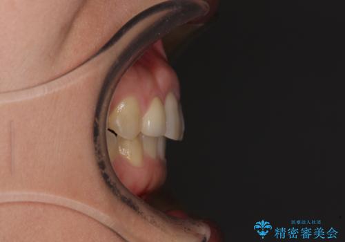 前歯の歯並びと小さい歯を改善 インビザラインとオールセラミッククラウンの治療後