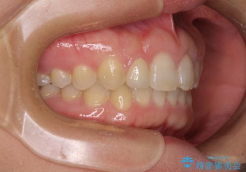 前歯の歯並びと小さい歯を改善 インビザラインとオールセラミッククラウンの治療後