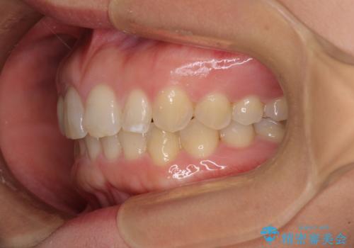 前歯の歯並びと小さい歯を改善 インビザラインとオールセラミッククラウンの治療後