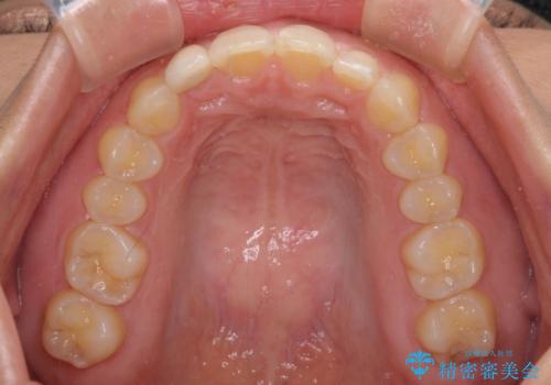 前歯の歯並びと小さい歯を改善　インビザラインとオールセラミッククラウンの治療後