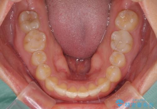 前歯の歯並びと小さい歯を改善　インビザラインとオールセラミッククラウンの治療後