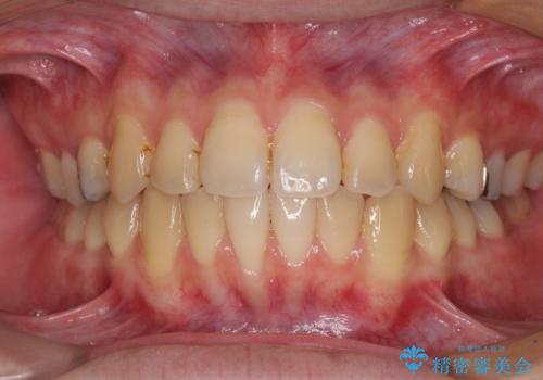 前歯のクロスバイトをインビザラインで矯正治療の治療中