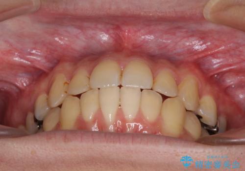 前歯のクロスバイトをインビザラインで矯正治療の治療中