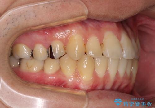 前歯のクロスバイトをインビザラインで矯正治療の治療中