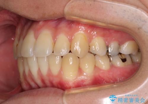 前歯のクロスバイトをインビザラインで矯正治療の治療中