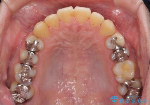 前歯のクロスバイトをインビザラインで矯正治療の治療中