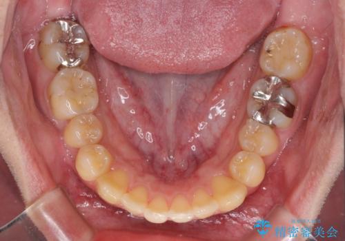 前歯のクロスバイトをインビザラインで矯正治療の治療中
