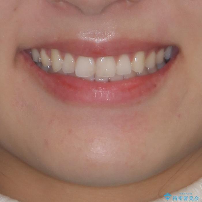上下の八重歯を治したい　補助装置を用いたインビザライン矯正の治療後（顔貌）
