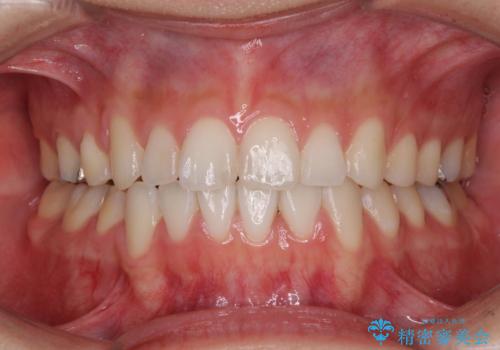 上下の八重歯を治したい　補助装置を用いたインビザライン矯正の症例 治療後