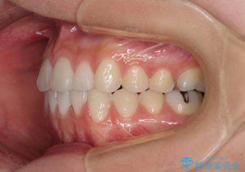上下の八重歯を治したい　補助装置を用いたインビザライン矯正の治療後