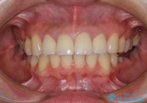 変色した歯をセラミックできれいにの治療後