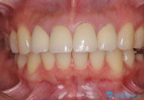 変色した歯をセラミックできれいにの治療後