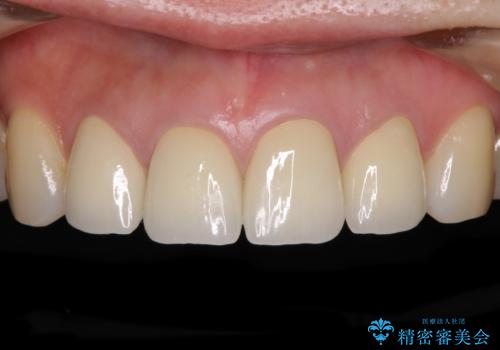変色した歯をセラミックできれいにの症例 治療後