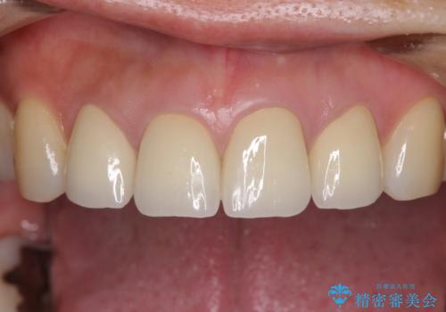 変色した歯をセラミックできれいにの治療後
