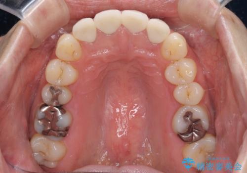 変色した歯をセラミックできれいにの治療後