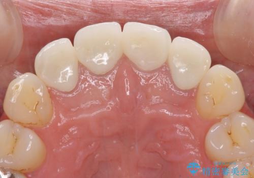 変色した歯をセラミックできれいにの治療後