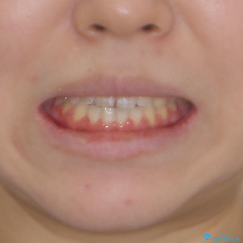 外科矯正は受けたくない 上顎骨拡大による妥協的な受け口治療の治療後(顔貌)