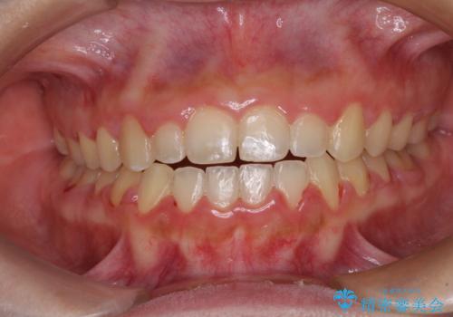 外科矯正は受けたくない 上顎骨拡大による妥協的な受け口治療の治療後