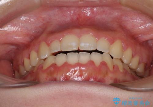 外科矯正は受けたくない 上顎骨拡大による妥協的な受け口治療の治療後