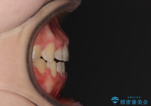 外科矯正は受けたくない 上顎骨拡大による妥協的な受け口治療の治療後