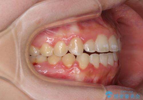 外科矯正は受けたくない 上顎骨拡大による妥協的な受け口治療の治療後