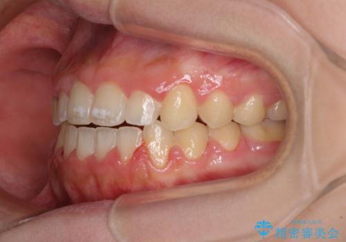 外科矯正は受けたくない 上顎骨拡大による妥協的な受け口治療の治療後