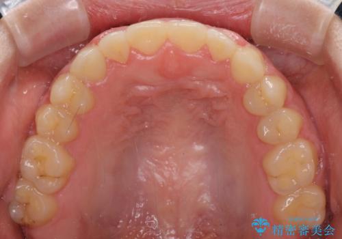 外科矯正は受けたくない 上顎骨拡大による妥協的な受け口治療の治療後