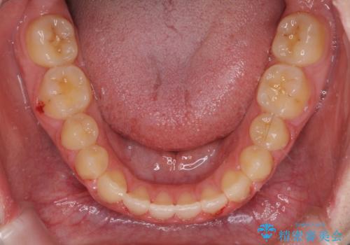 外科矯正は受けたくない 上顎骨拡大による妥協的な受け口治療の治療後