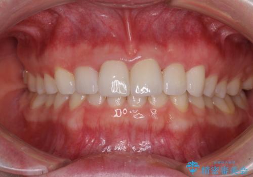 気になる前歯を美しく マウスピース矯正とセラミッククラウンの症例 治療後