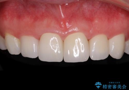 気になる前歯を美しく マウスピース矯正とセラミッククラウンの治療後