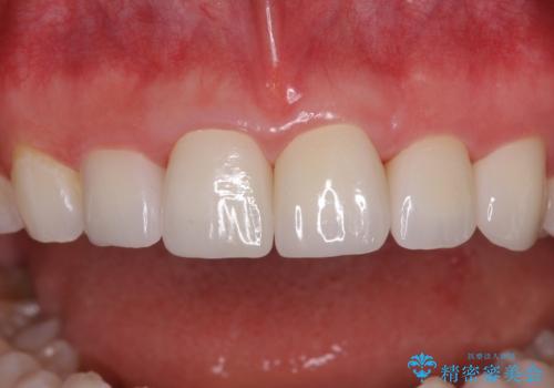 気になる前歯を美しく マウスピース矯正とセラミッククラウンの治療後