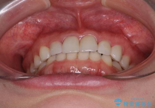 気になる前歯を美しく マウスピース矯正とセラミッククラウンの治療後