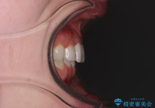 気になる前歯を美しく マウスピース矯正とセラミッククラウンの治療後