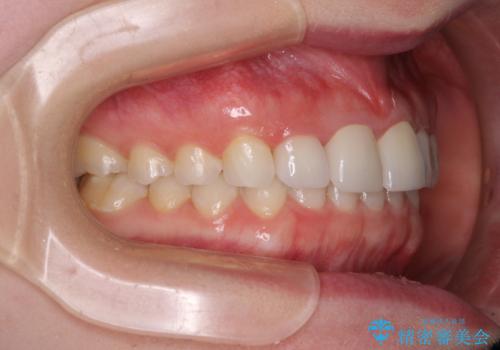 気になる前歯を美しく マウスピース矯正とセラミッククラウンの治療後