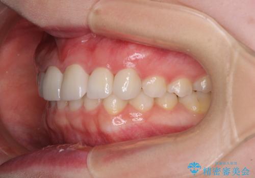 気になる前歯を美しく　マウスピース矯正とセラミッククラウンの治療後