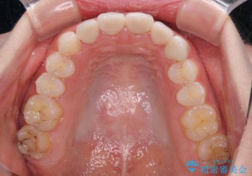 気になる前歯を美しく マウスピース矯正とセラミッククラウンの治療後