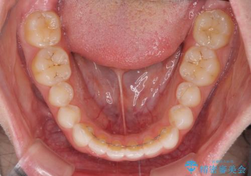 気になる前歯を美しく マウスピース矯正とセラミッククラウンの治療後