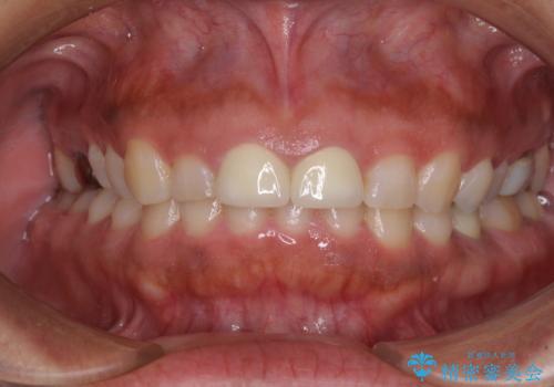 長さの気になる変色した前歯をオールセラミッククラウンにの治療後