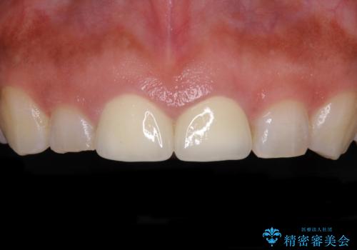 長さの気になる変色した前歯をオールセラミッククラウンにの症例 治療後
