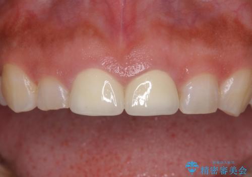 長さの気になる変色した前歯をオールセラミッククラウンにの治療後