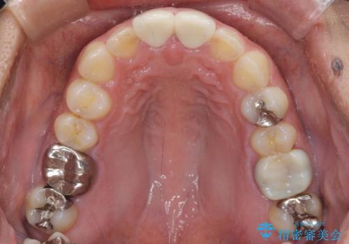 長さの気になる変色した前歯をオールセラミッククラウンにの治療後