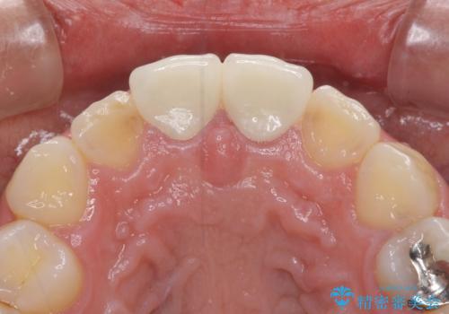長さの気になる変色した前歯をオールセラミッククラウンにの治療後